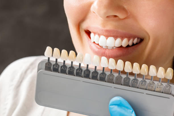 Which is better porcelain or composite veneers?
