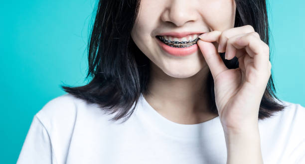 Smiling Confidently: Braces Care and Orthodontic Options