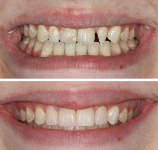 Full Mouth Dental Implants Before & After Journeys