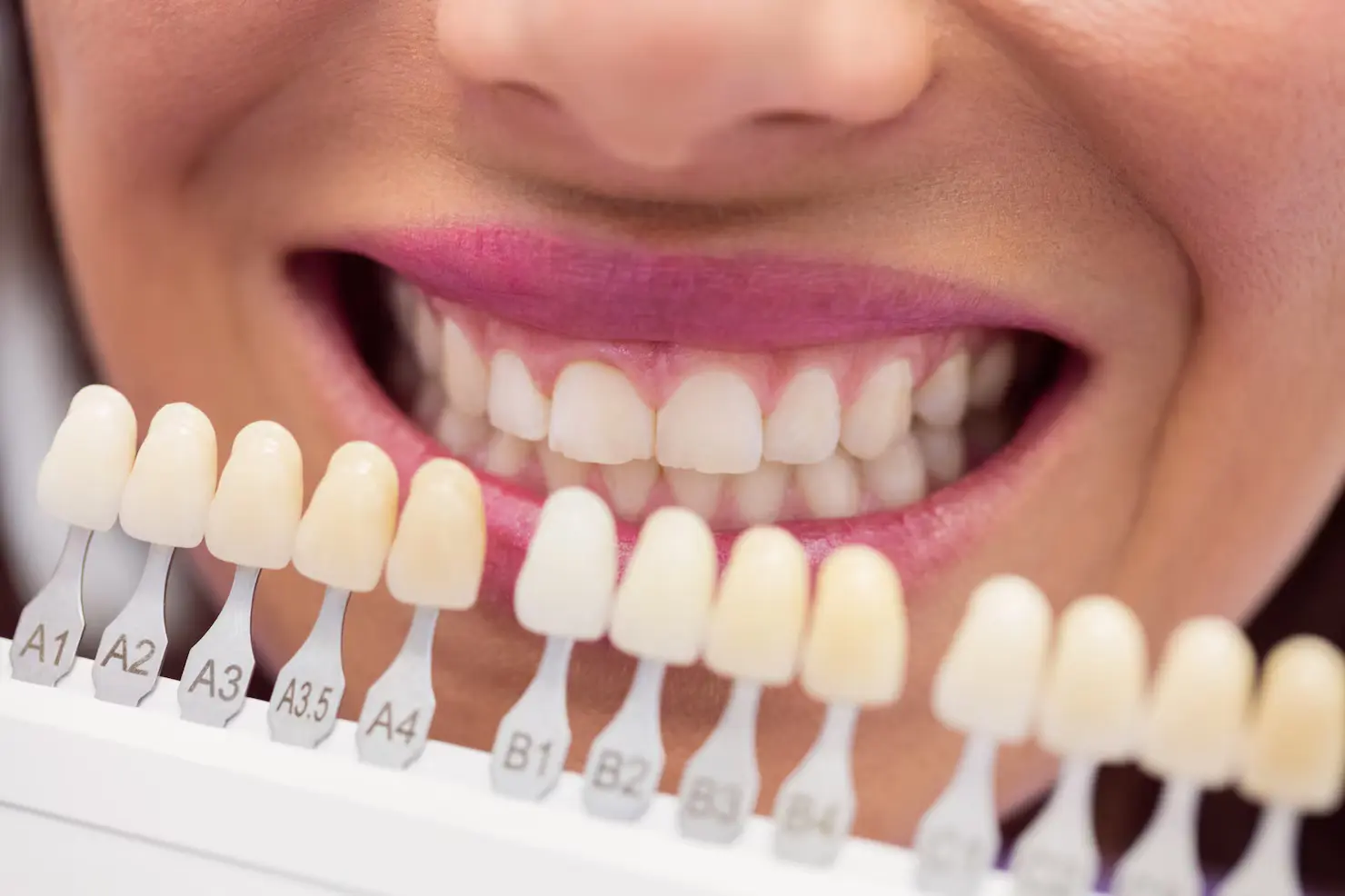 How to Decide if Dental Veneers Are Right for You
