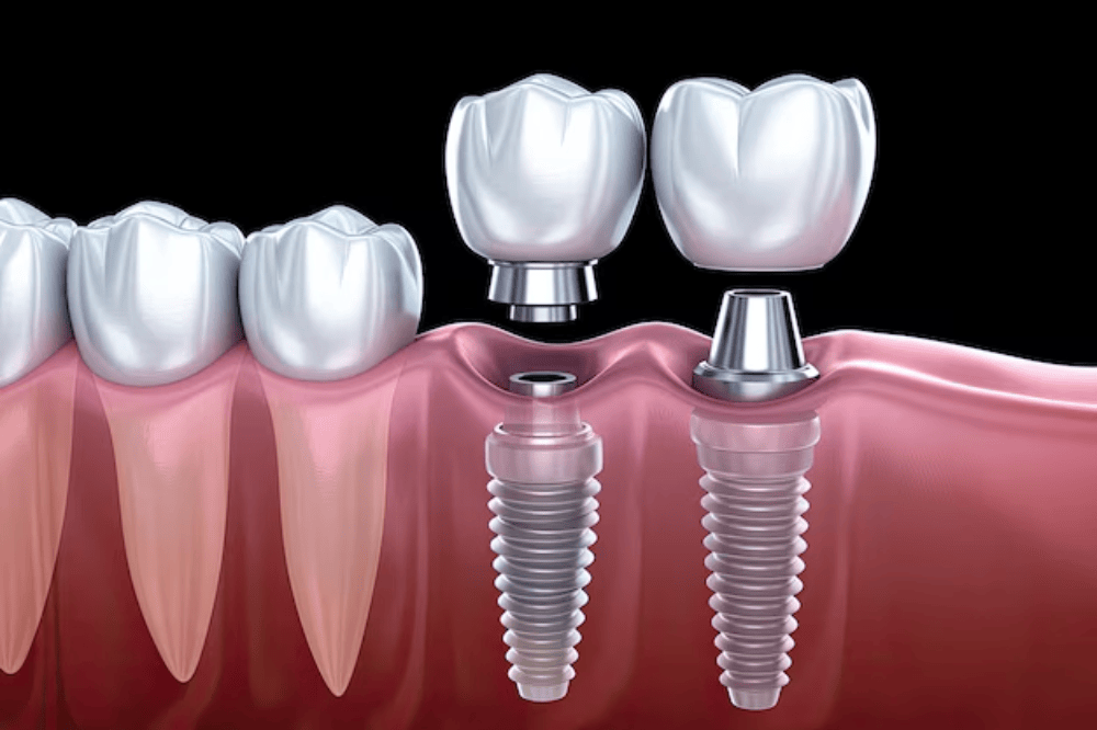 How Dental Implants Preserve Jawbone Health & Oral Function